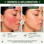 Before and after comparison of a woman's face with redness and inflammation, showing visible improvement after 4 weeks.
